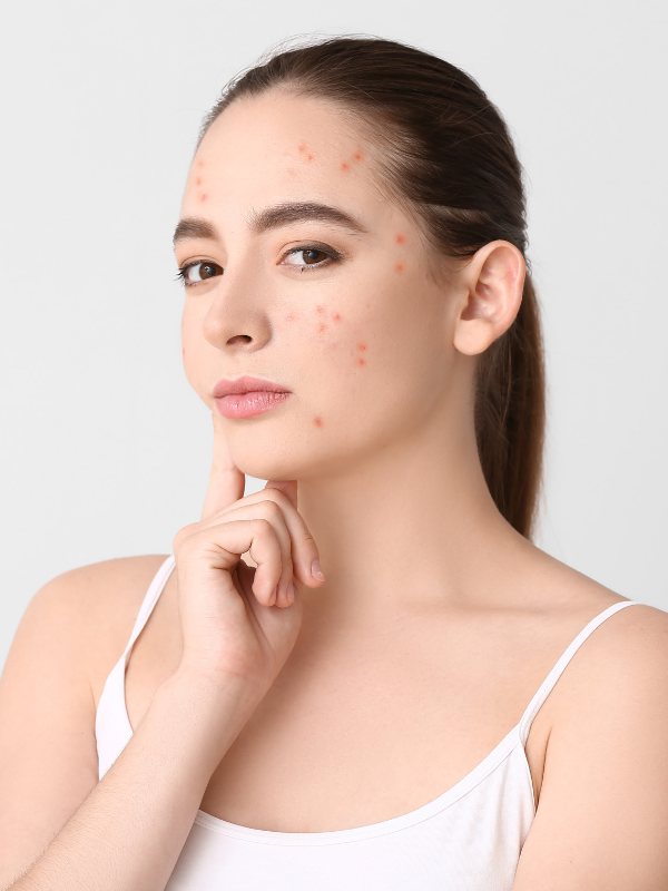 acne clinic los angeles